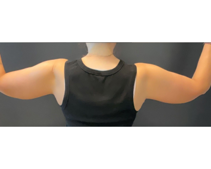 Brachioplasty Before & After Patient #16560