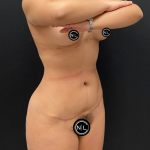 Liposuction Before & After Patient #16562