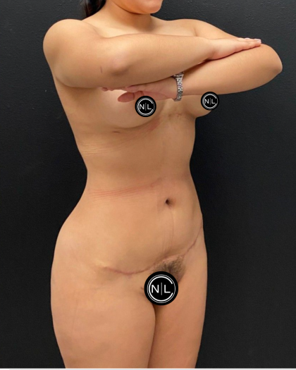 Liposuction Before & After Patient #16562