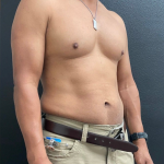 Weight Loss Before & After Patient #16530