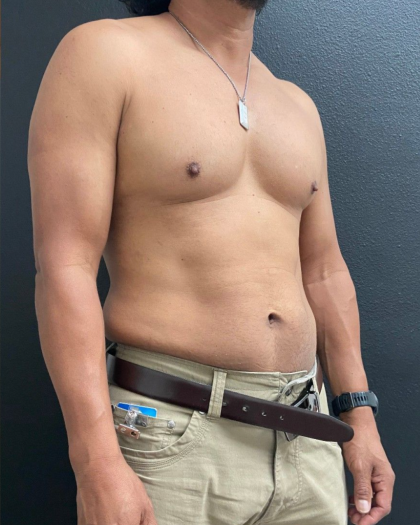 Weight Loss Before & After Patient #16530