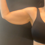 Brachioplasty Before & After Patient #16560