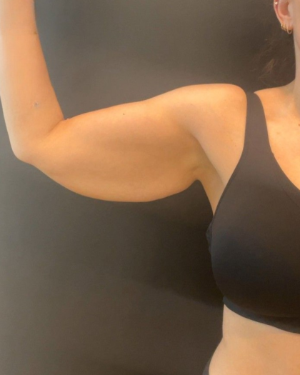 Brachioplasty Before & After Patient #16560