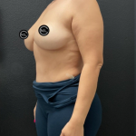 Breast Augmentation Before & After Patient #16528
