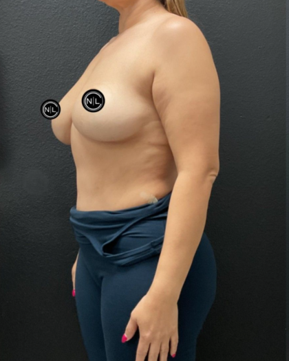 Breast Augmentation Before & After Patient #16528