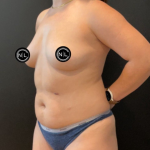 Breast Augmentation Before & After Patient #16561