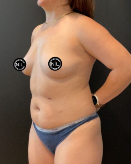 Breast Augmentation Before & After Patient #16561