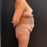 Breast Reduction Before & After Patient #16557
