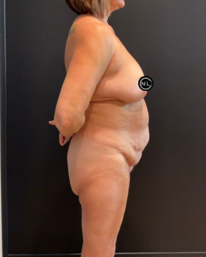 Breast Reduction Before & After Patient #16557