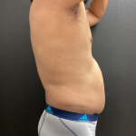 Weight Loss Before & After Patient #16530