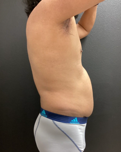 Weight Loss Before & After Patient #16530
