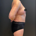 Abdominoplasty Before & After Patient #16563