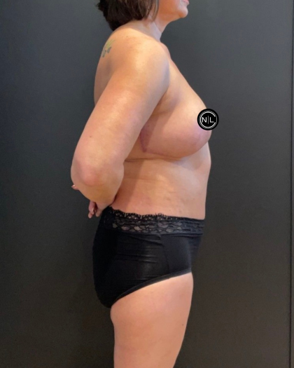 Abdominoplasty Before & After Patient #16563