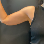 Brachioplasty Before & After Patient #16560