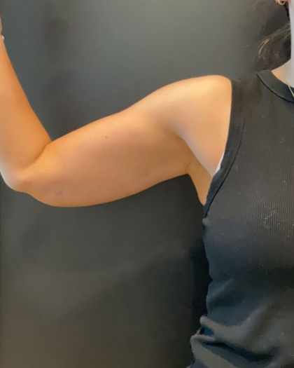 Brachioplasty Before & After Patient #16560