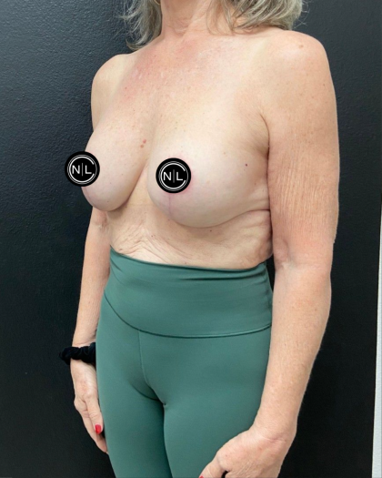 Breast Augmentation Before & After Patient #16529