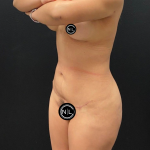 Liposuction Before & After Patient #16562
