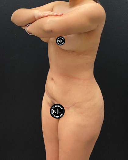 Liposuction Before & After Patient #16562