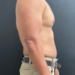 Weight Loss Before & After Patient #16530