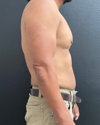 Weight Loss Before & After Patient #16530