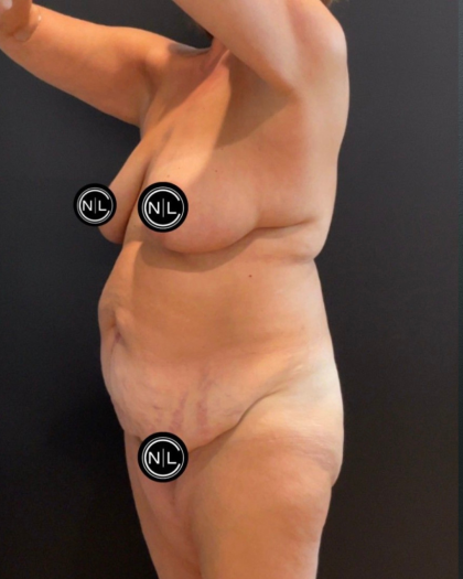 Abdominoplasty Before & After Patient #16563