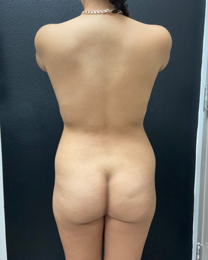 Liposuction Before & After Patient #16562