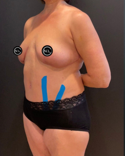 Abdominoplasty Before & After Patient #16563