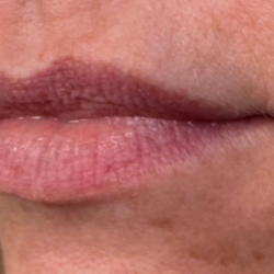 Lip Filler Before & After Patient #16693