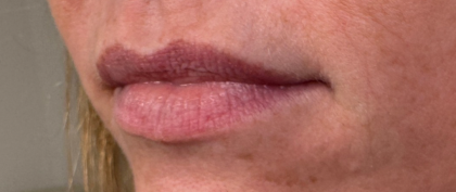 Lip Filler Before & After Patient #16693