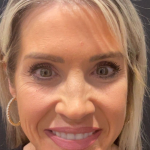 Sculptra Before & After Patient #16684