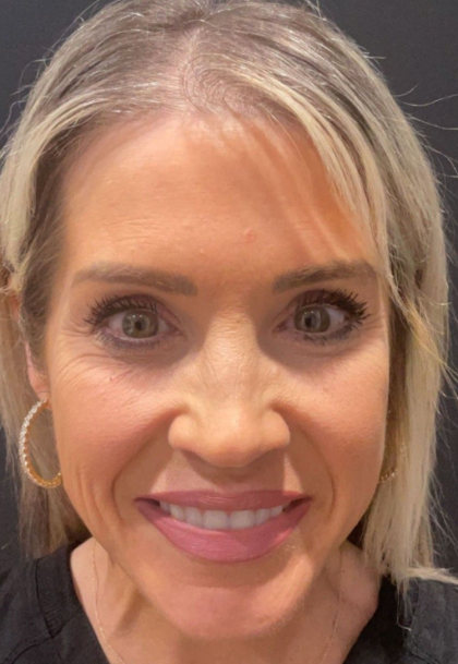 Sculptra Before & After Patient #16684