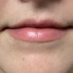 Lip Filler Before & After Patient #16694