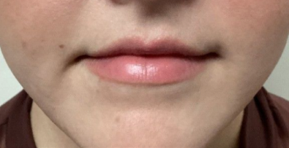 Lip Filler Before & After Patient #16694