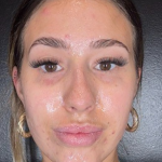 Microneedling Before & After Patient #16686