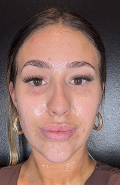 Microneedling Before & After Patient #16686