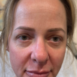 CO2 Laser Before & After Patient #16695