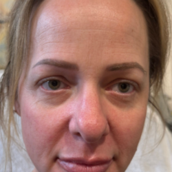 CO2 Laser Before & After Patient #16695