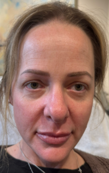 CO2 Laser Before & After Patient #16695