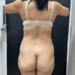 Brazilian Butt Lift Before & After Patient #16689