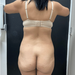 Brazilian Butt Lift Before & After Patient #16689