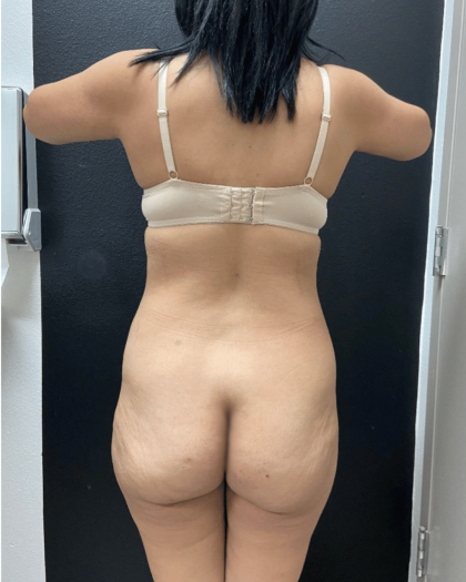 Brazilian Butt Lift Before & After Patient #16689