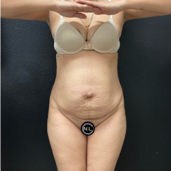 Mommy Makeover Before & After Patient #16691
