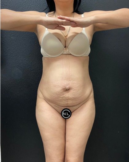Mommy Makeover Before & After Patient #16691