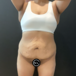 Mommy Makeover Before & After Patient #16692