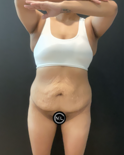 Mommy Makeover Before & After Patient #16692