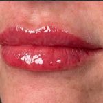 Lip Filler Before & After Patient #16693