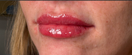 Lip Filler Before & After Patient #16693