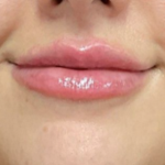 Lip Filler Before & After Patient #16694