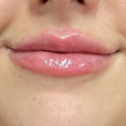 Lip Filler Before & After Patient #16694