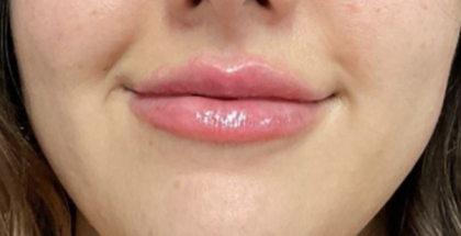Lip Filler Before & After Patient #16694